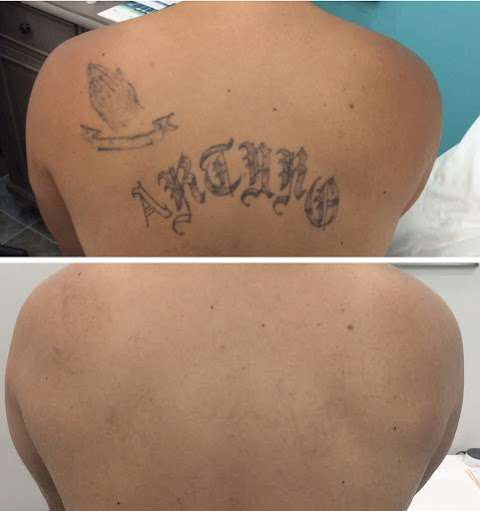 Bare Tattoo & Hair Removal - Laser Tattoo Removal Chicago